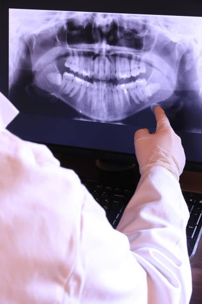 Best Knocked-Out Tooth (Avulsed Tooth) Treatment in Sarasota Springs, FL