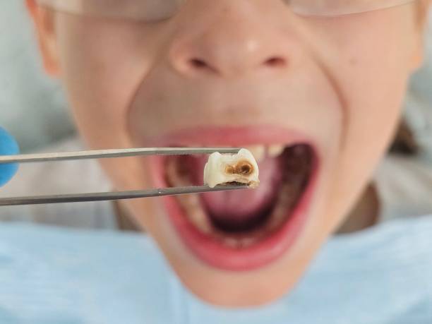 Best Broken or Chipped Tooth Repair in Sarasota Springs, FL