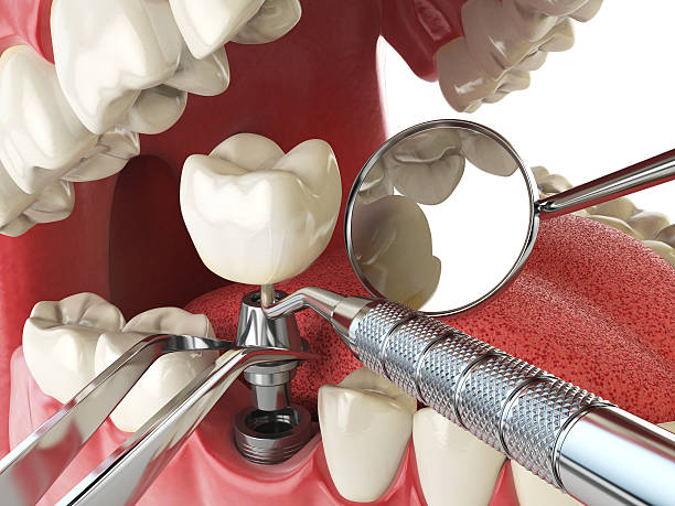 Best Emergency Denture Repair in Sarasota Springs, FL